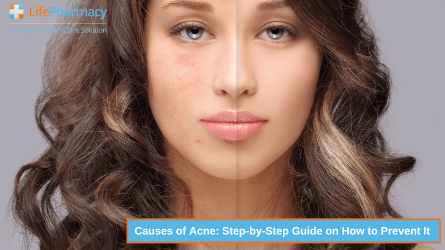 Causes of Acne: Step-by-Step Guide on How to Prevent It
