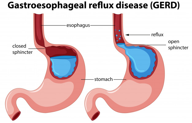 How to deal with the heartburn & signs that indicate heartburn