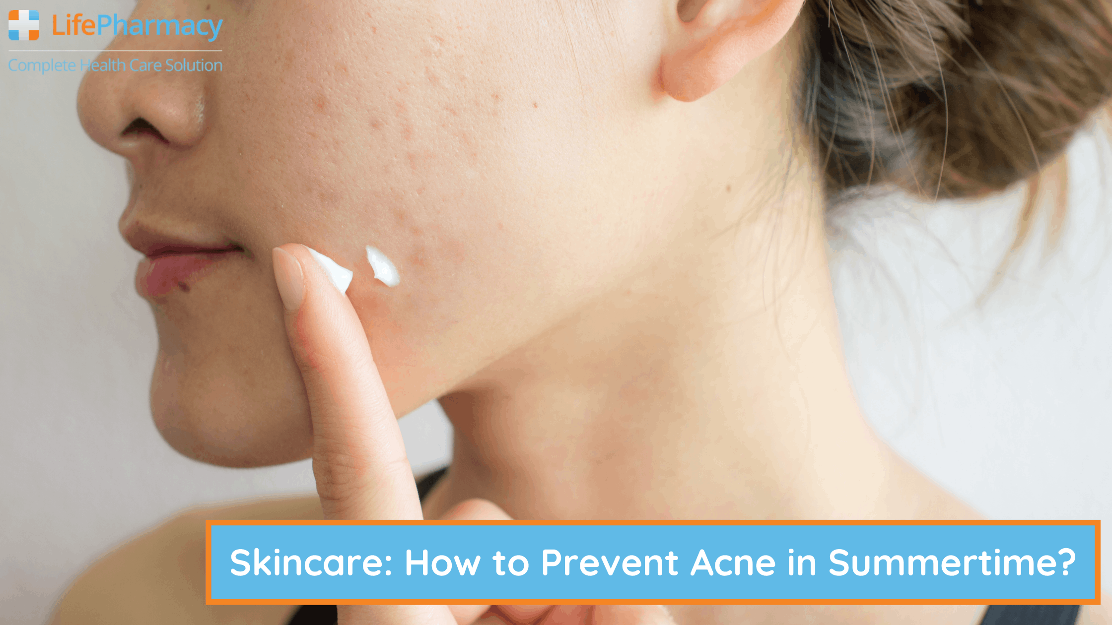 Skincare: How to Prevent Acne in Summertime?