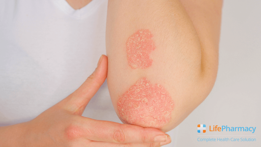 FUNGAL INFECTION ON THE SKIN: TYPES, SYMPTOMS, AND HOW TO PREVENT IT?