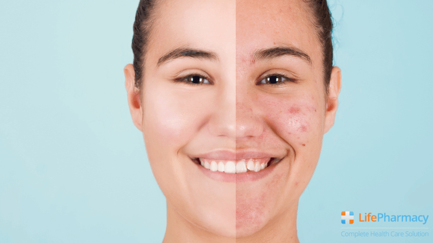 CAUSES OF ACNE: STEP-BY-STEP GUIDE ON HOW TO PREVENT IT