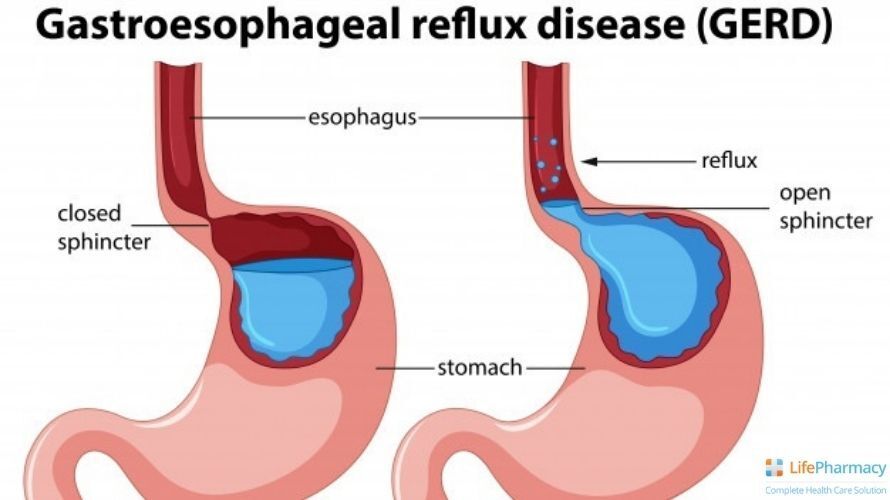COMPLETE GUIDE ON HEARTBURN: CAUSES, SYMPTOMS, AND TREATMENT